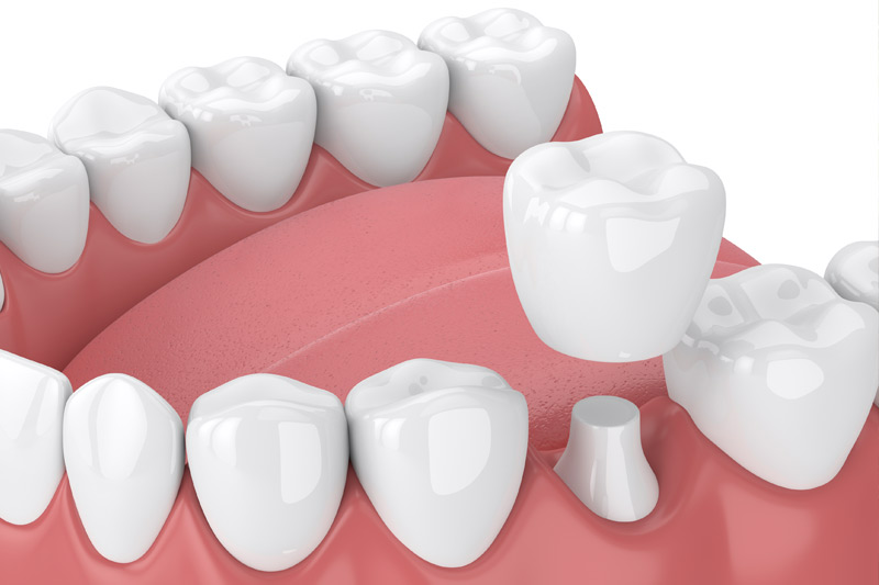 Dental Crowns in Bellflower