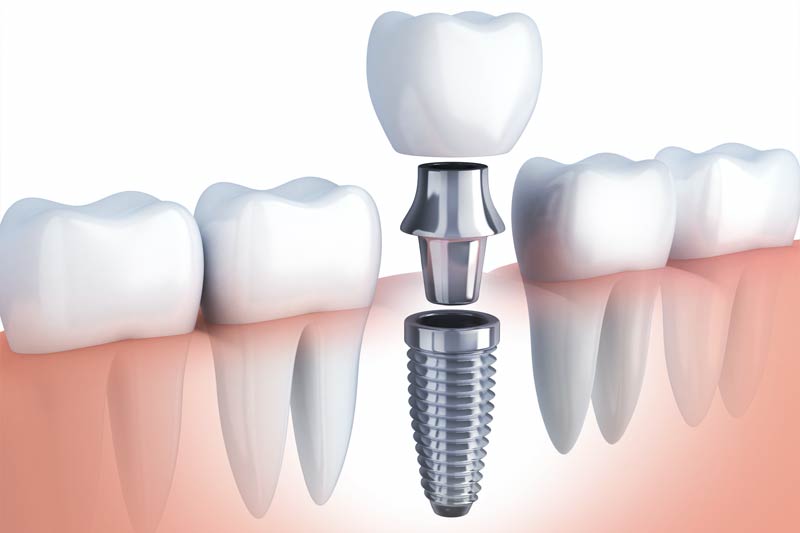 Implants Dentist in Bellflower