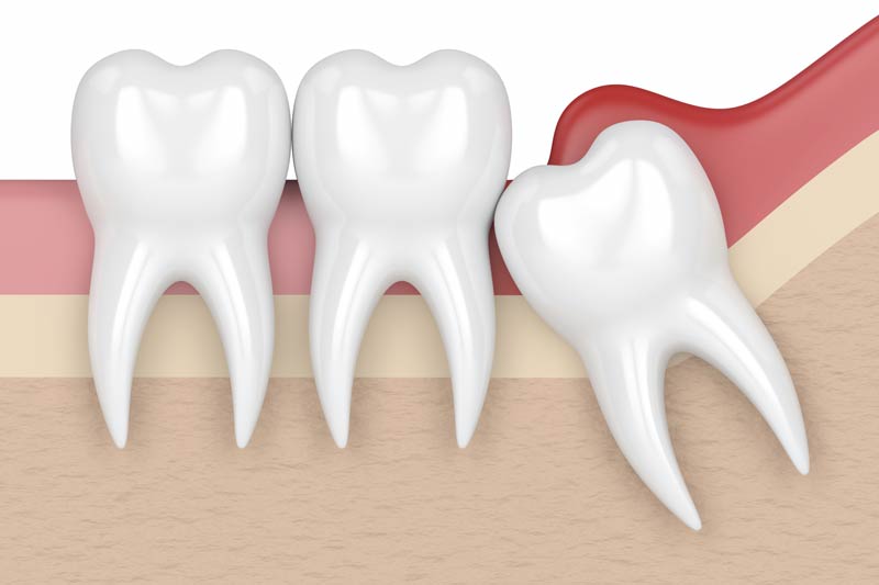 Wisdom Tooth Removal in Bellflower