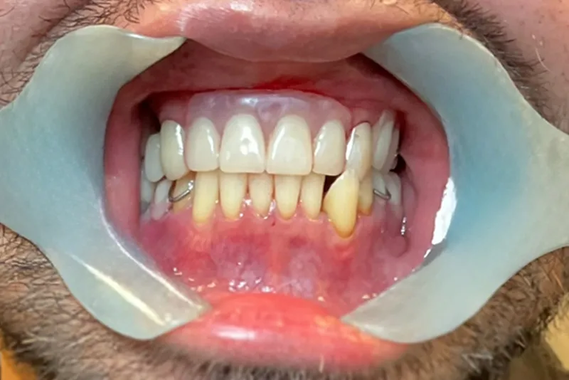Teeth with dental retractor in place