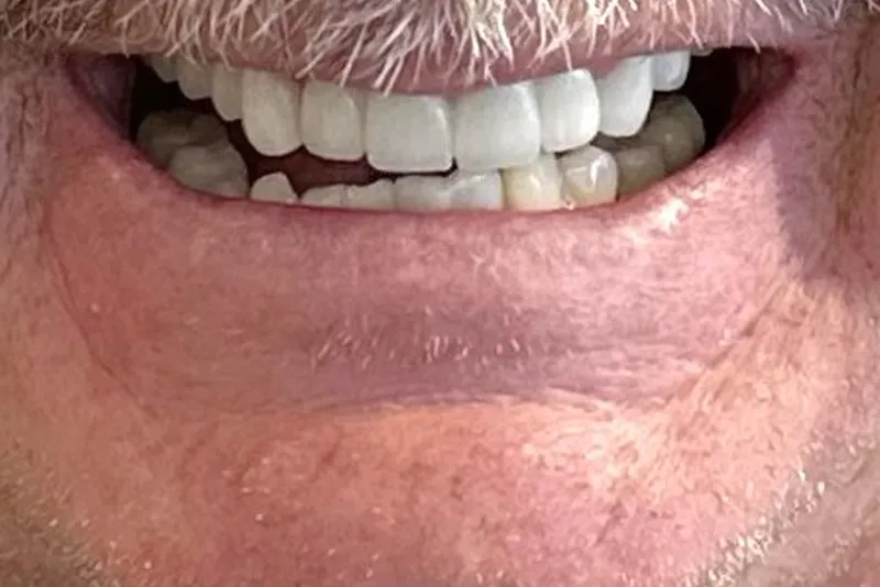 Teeth and lips in a smile