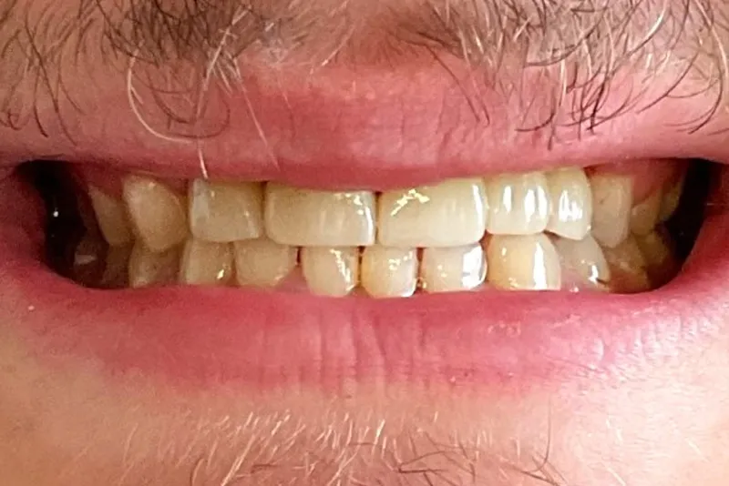Teeth showing in a wide smile