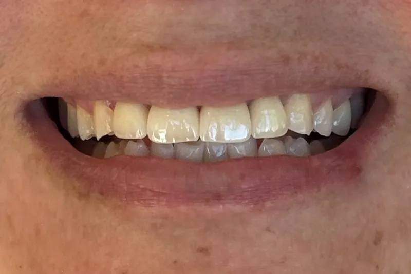 Healthy teeth in a smiling mouth