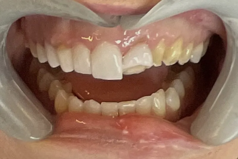 Chipped front tooth close-up
