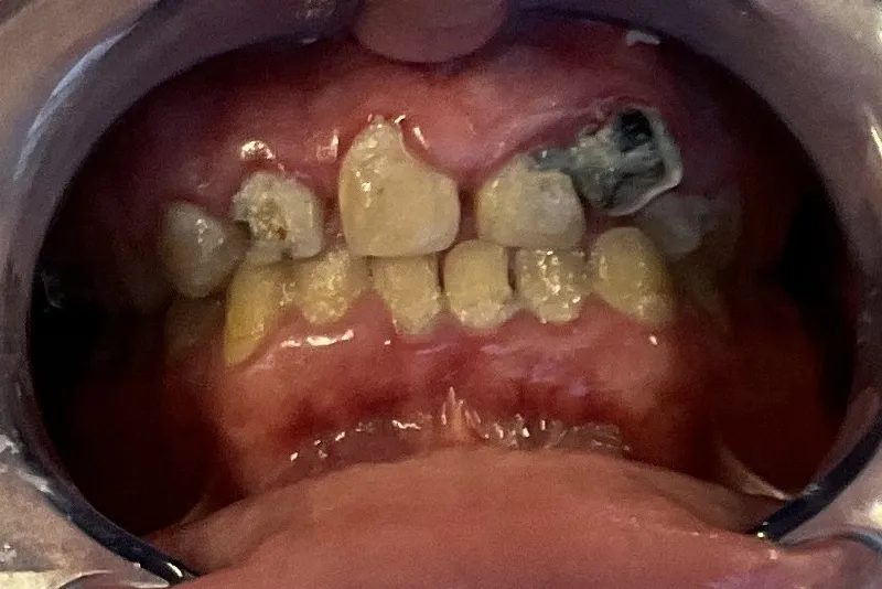 Damaged teeth and gum condition