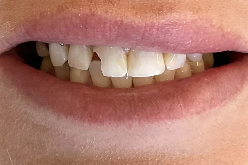 Teeth with slight gap and natural lips