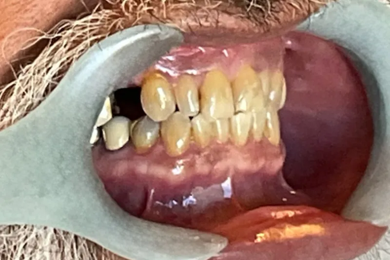 Dental examination showing teeth and gums