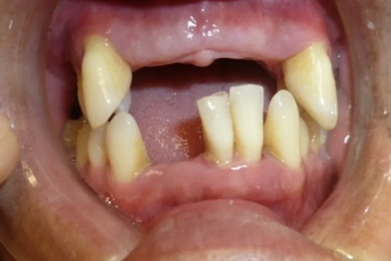 Close-up of misaligned teeth