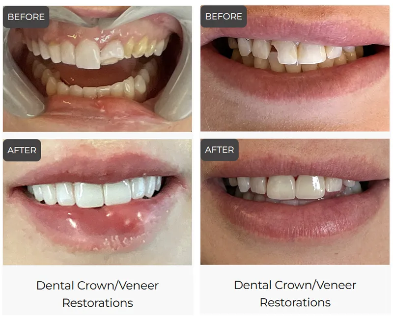 Teeth transformation with crowns and veneers